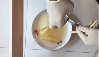 فض الغشاء البكارة الرعشة